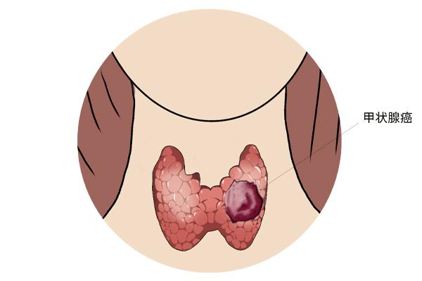 甲狀腺癌癥的主要癥狀表現(xiàn)有什么？為什么會得甲狀腺癌癥呢？