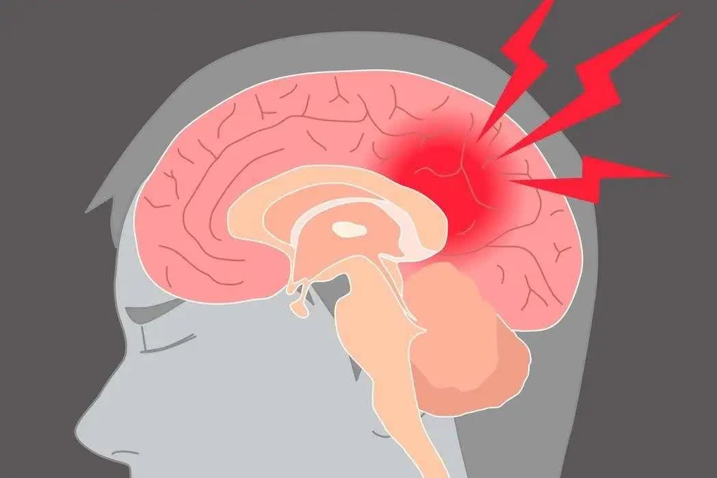 預(yù)防腦梗從習(xí)慣做起，這三大壞習(xí)慣，有的趕緊改正！